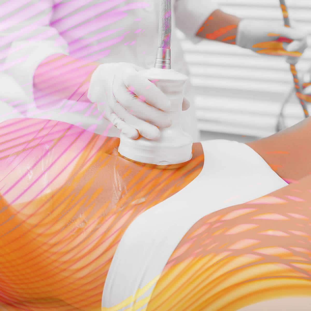 Ultrasound Cavitation treatment illustration